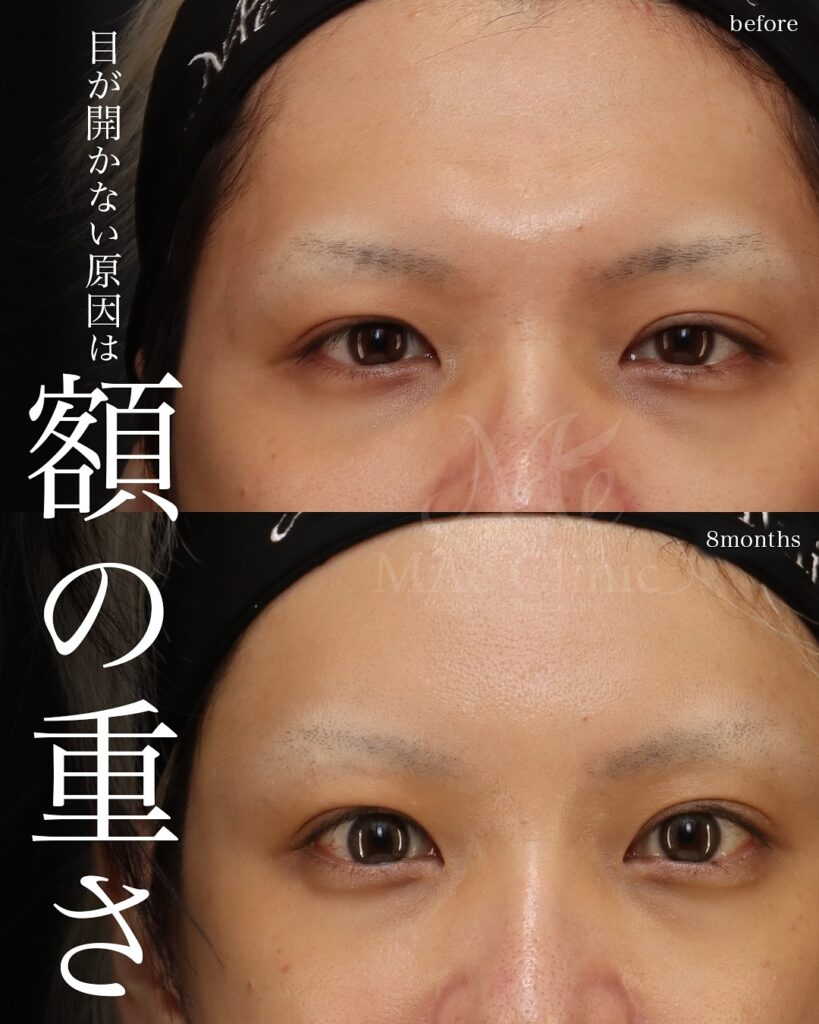前額形成(前頭洞セットバック) 前額リフト 症例