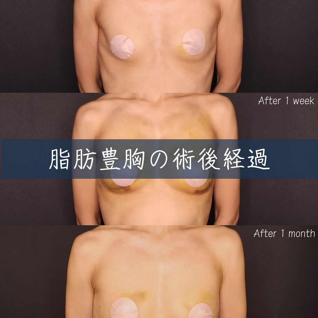 症例解説】脂肪注入豊胸のダウンタイムとは？術後1ヶ月のリアルな経過