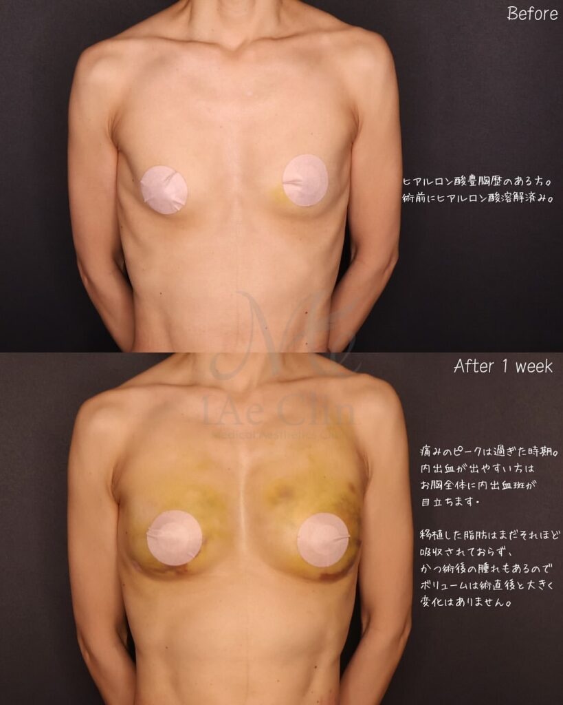 脂肪注入豊胸 経過の症例写真