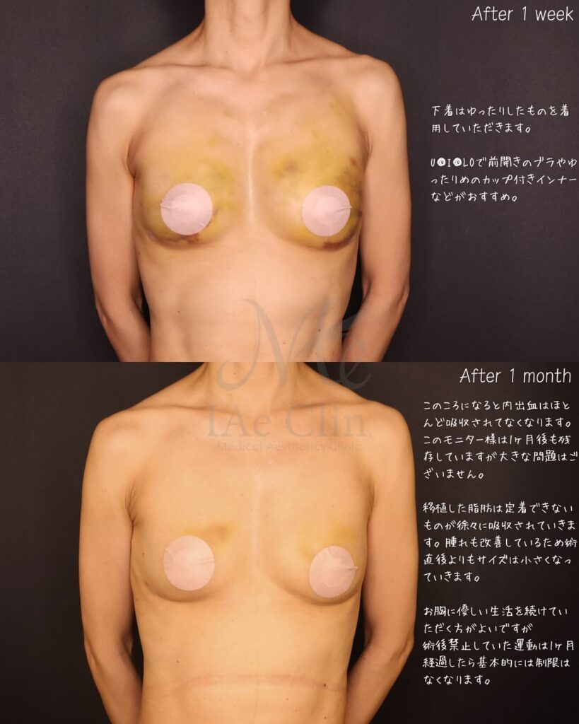 脂肪注入豊胸 経過の症例写真