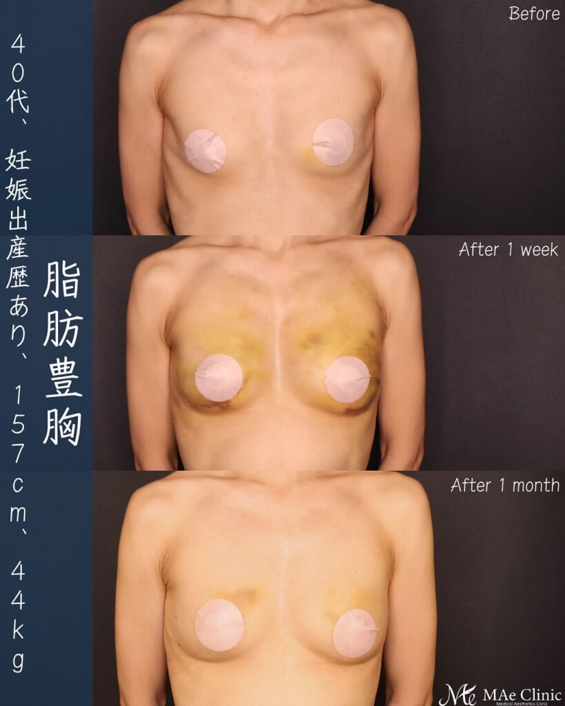 脂肪注入豊胸 経過の症例写真
