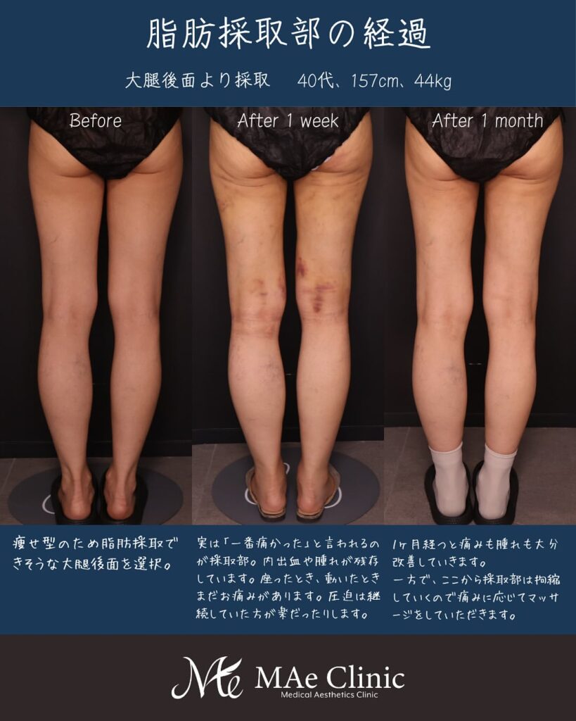 脂肪注入豊胸 経過の症例写真