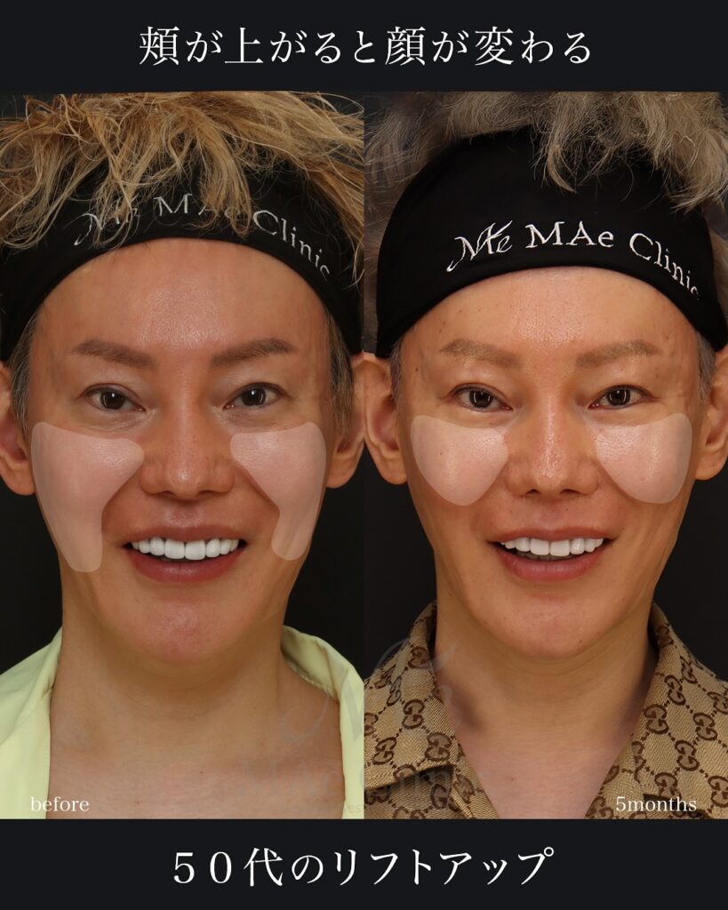口角挙上 中顔面リフト(ミッドフェイスリフト) 術後１ヵ月　症例写真