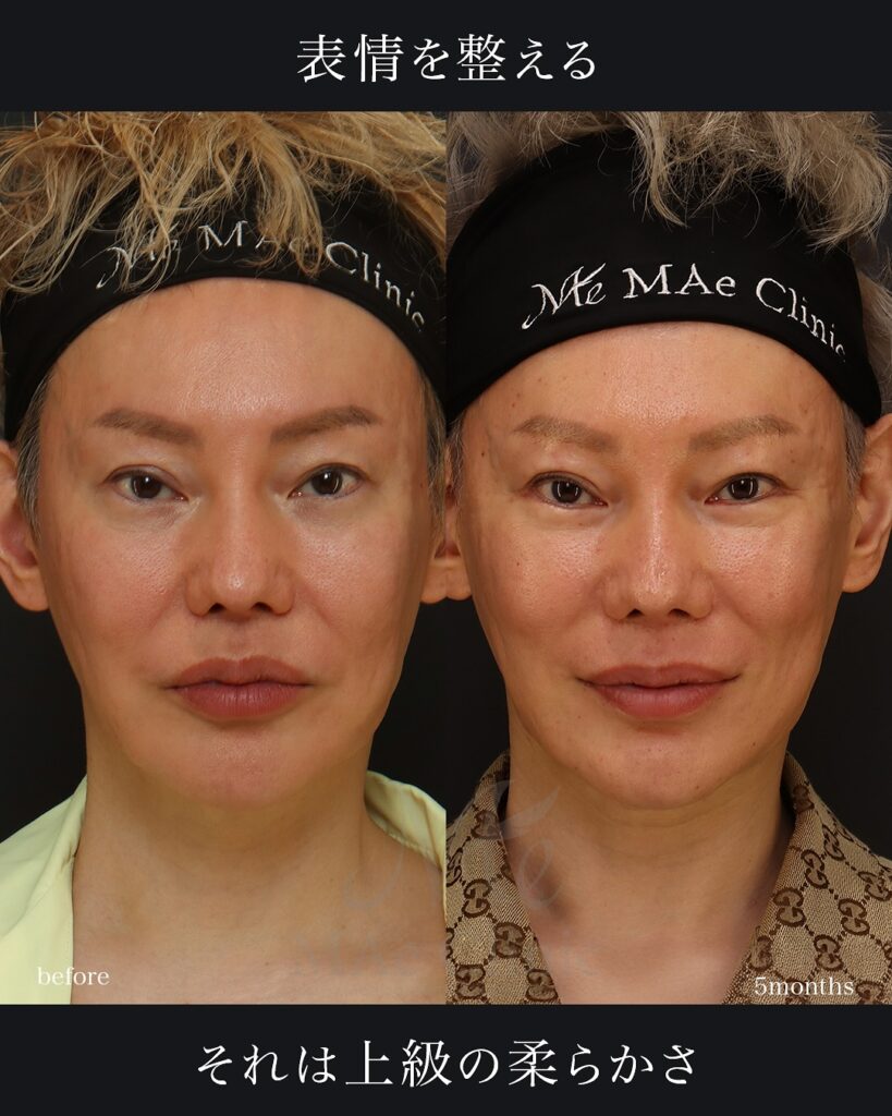 口角挙上 中顔面リフト(ミッドフェイスリフト) 術後１ヵ月　症例写真