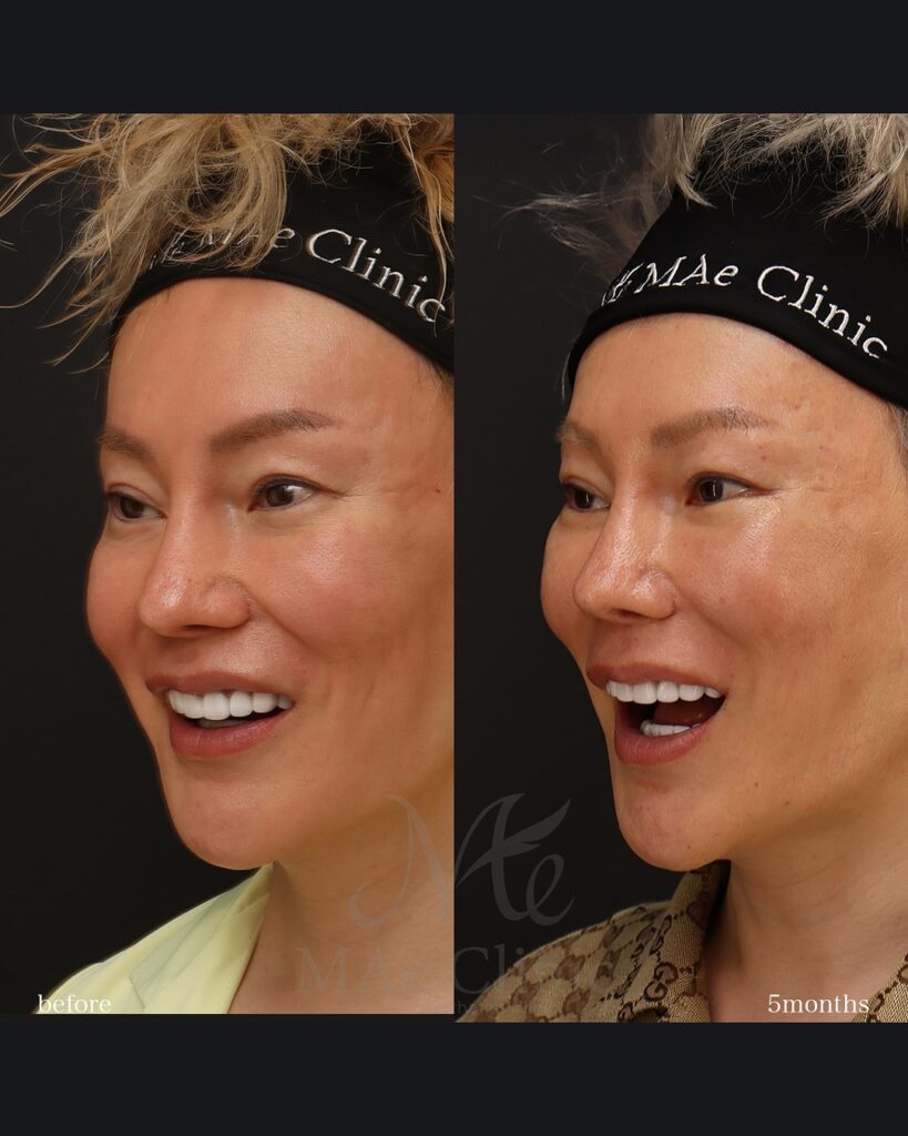 口角挙上 中顔面リフト(ミッドフェイスリフト) 術後１ヵ月　症例写真