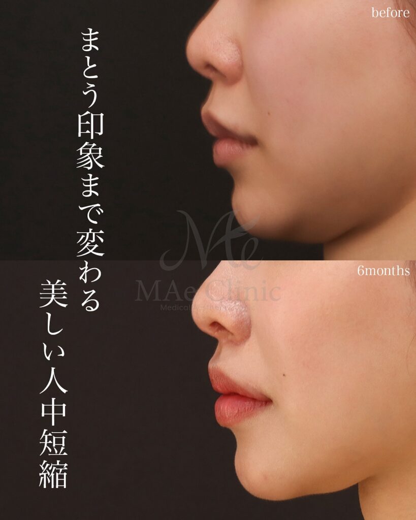 人中短縮 人中厚み調整3D 外側人中短縮 6ヶ月後症例