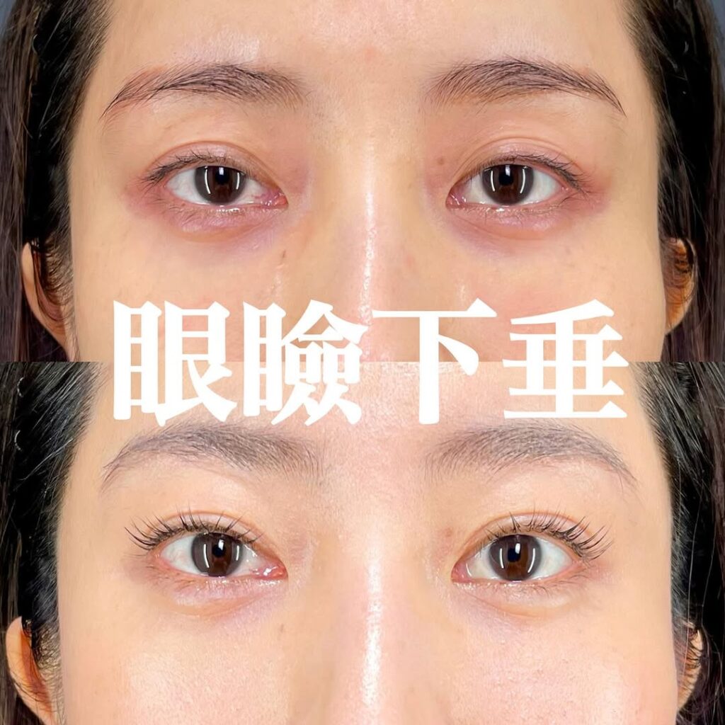 眼瞼下垂症例