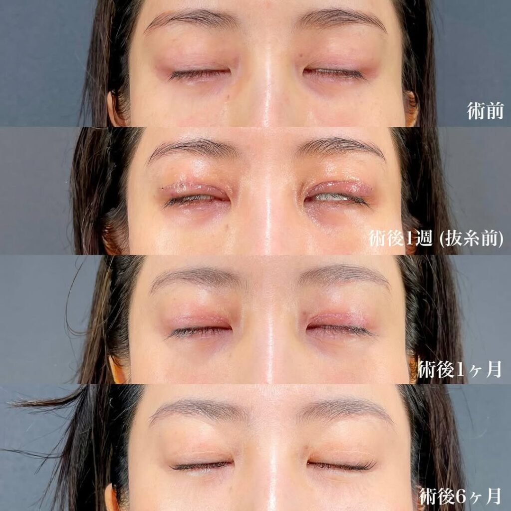 眼瞼下垂症例