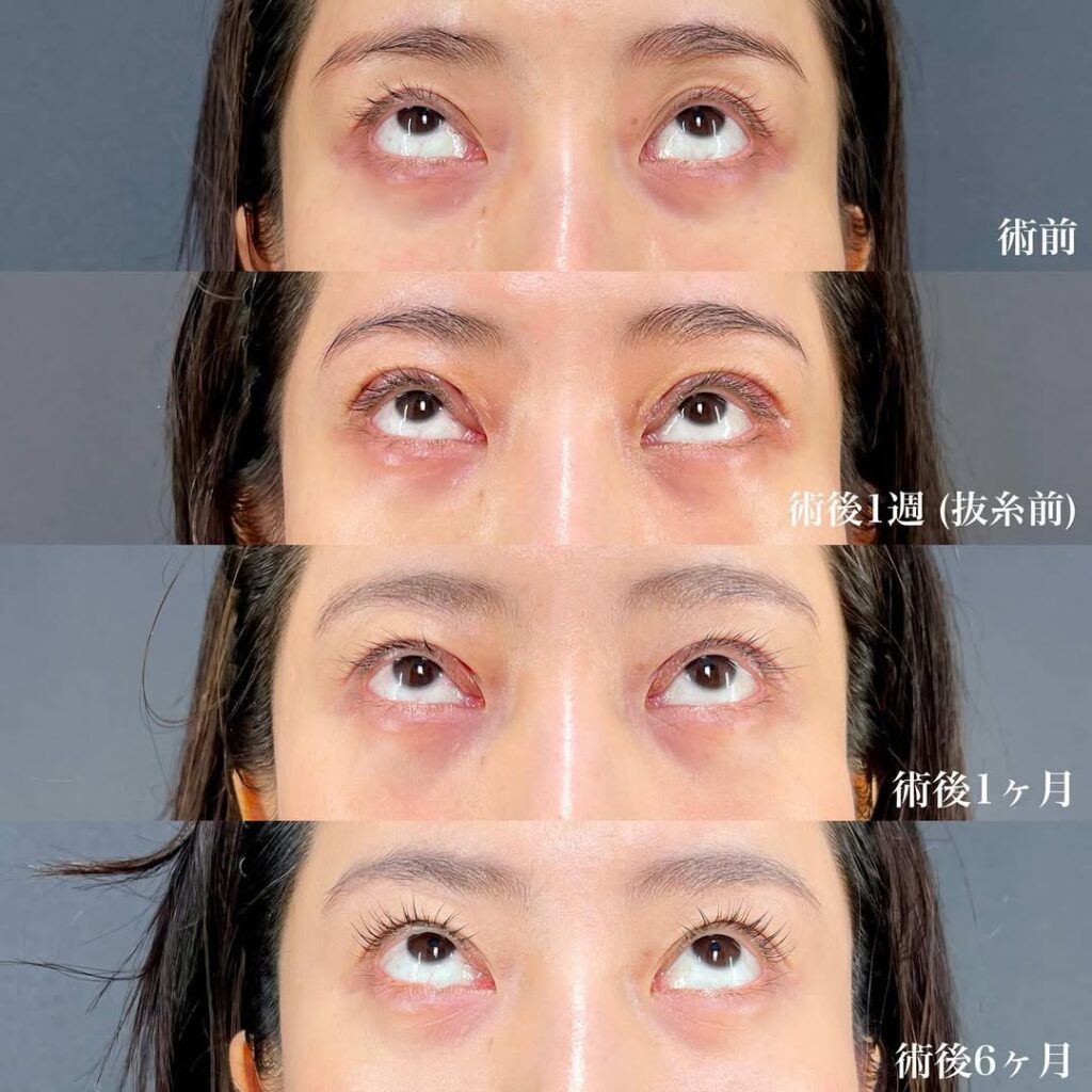 眼瞼下垂症例