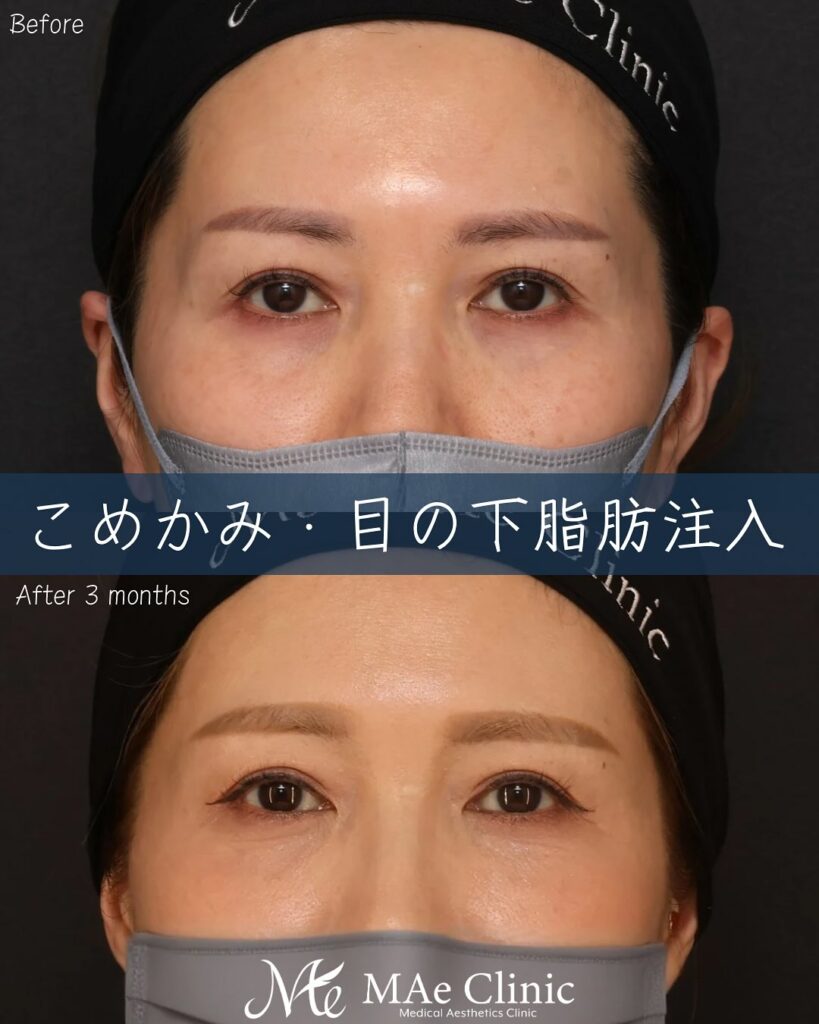 脂肪注入(こめかみ、目の下〜ゴルゴ)症例