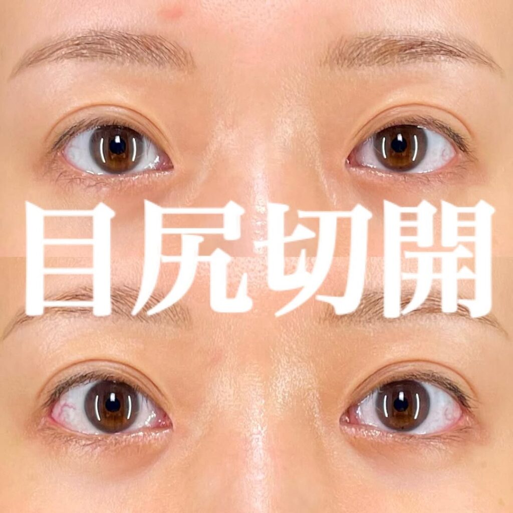 目尻切開+目頭切開リドレープ法×術後3ヶ月 症例
