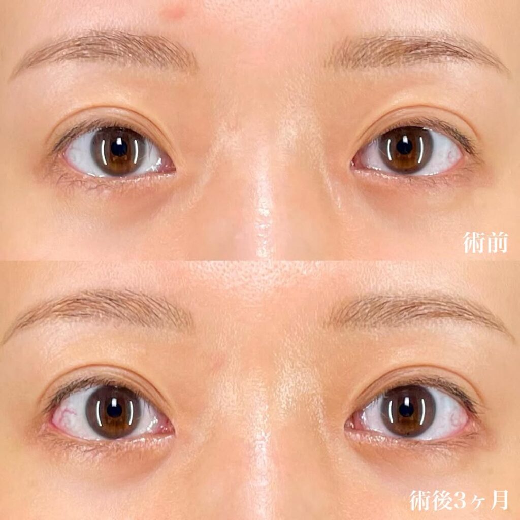 目尻切開+目頭切開リドレープ法×術後3ヶ月 症例