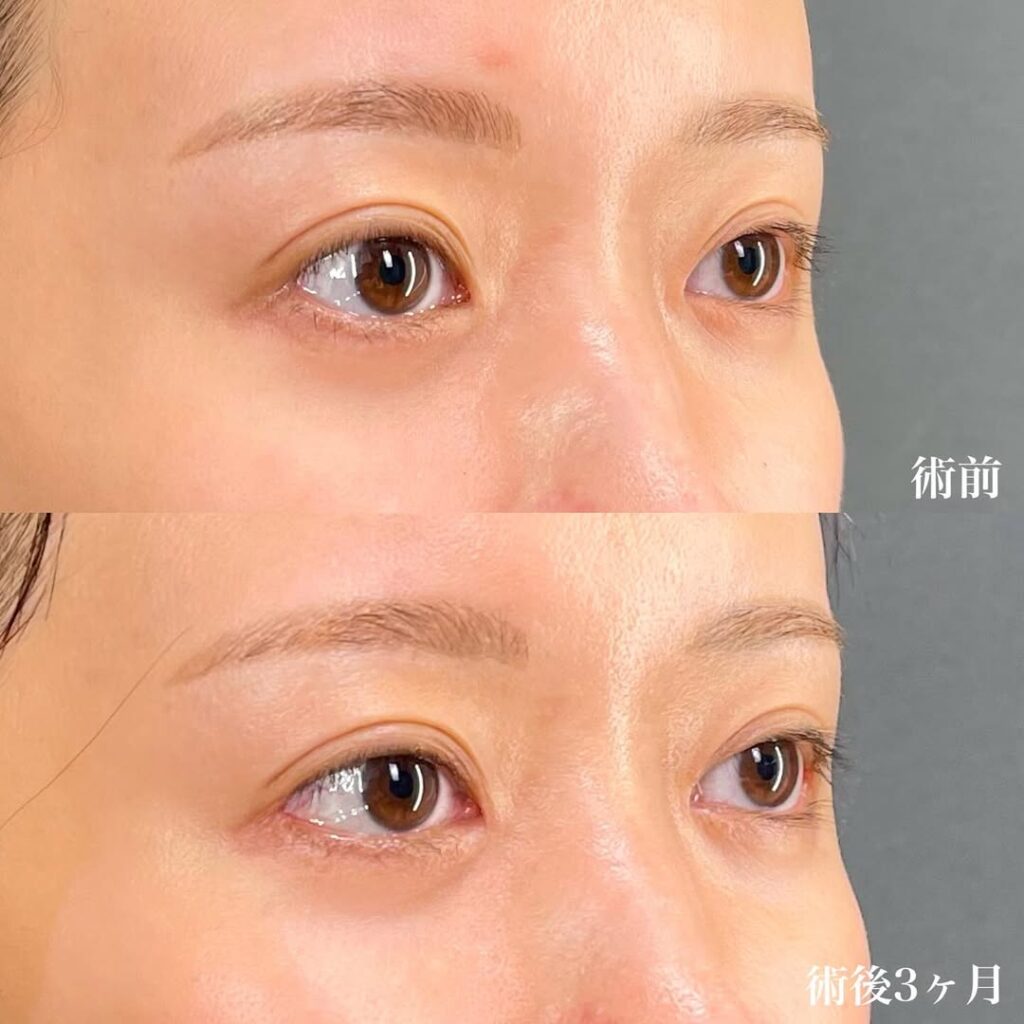 目尻切開+目頭切開リドレープ法×術後3ヶ月 症例