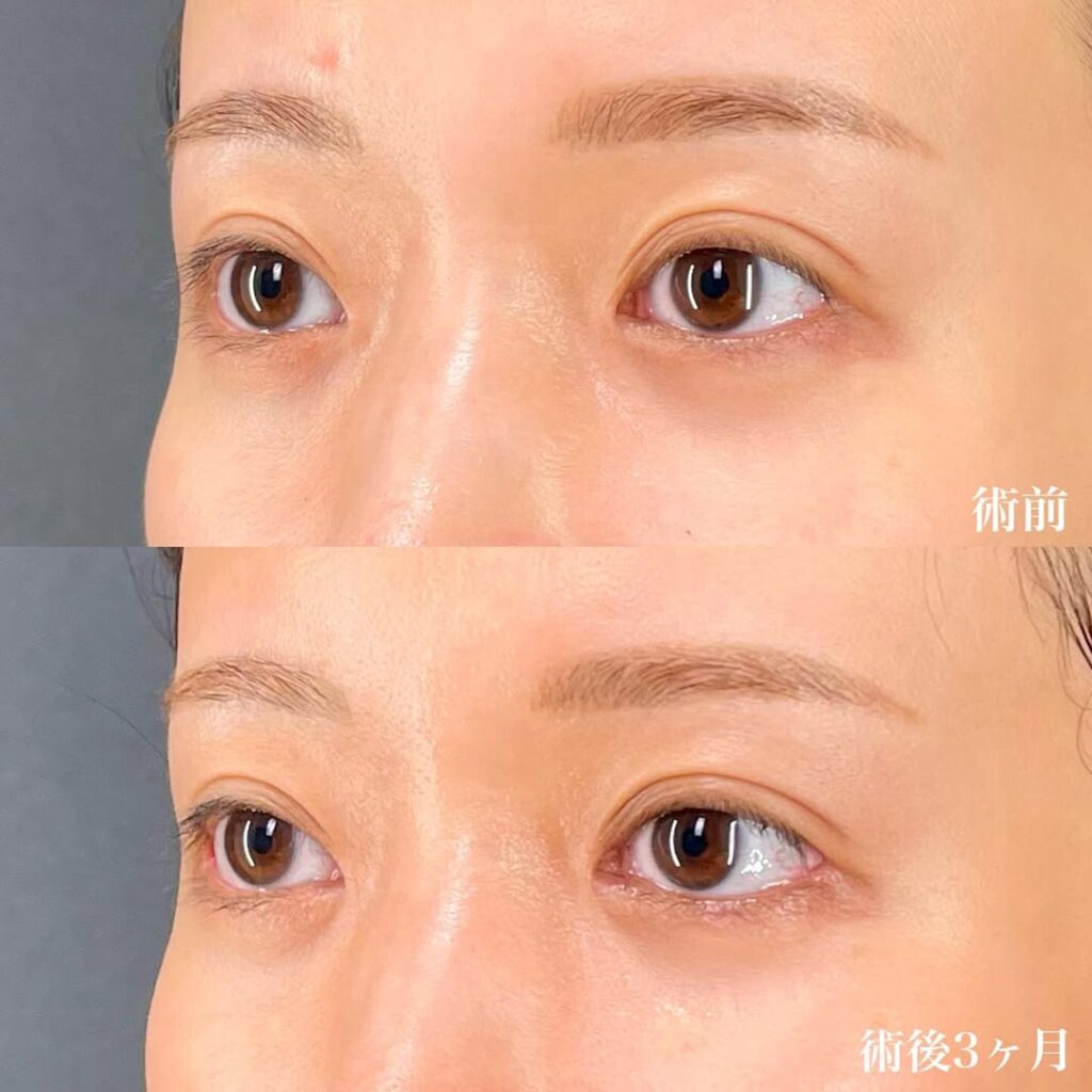 目尻切開+目頭切開リドレープ法×術後3ヶ月 症例