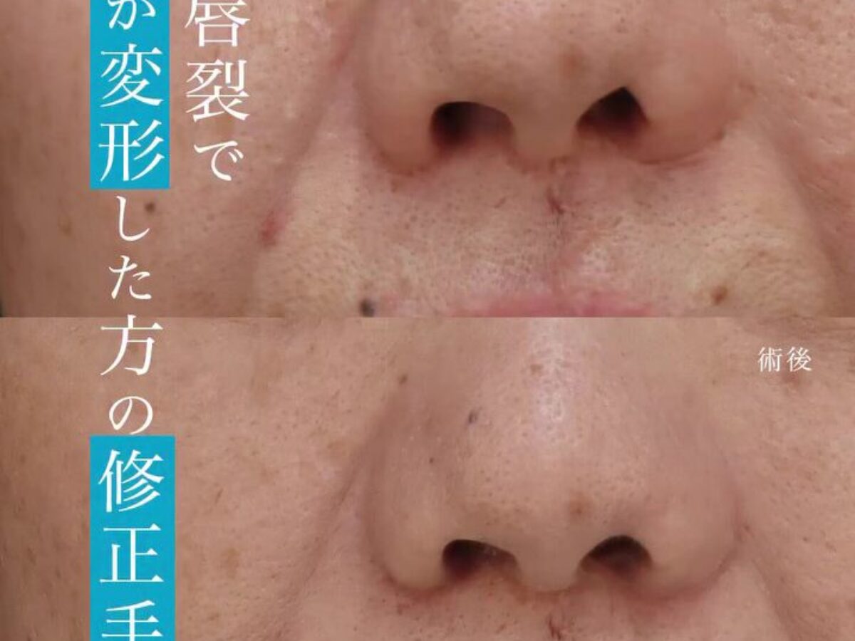 【美品】目で見る口唇裂手術 症例解説】口唇裂で変形した鼻の修正手術｜耳介軟骨＋皮膚の一体移植で