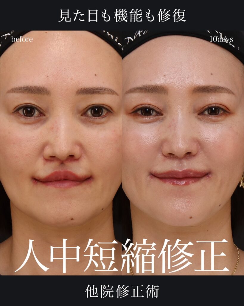 人中短縮修正 症例