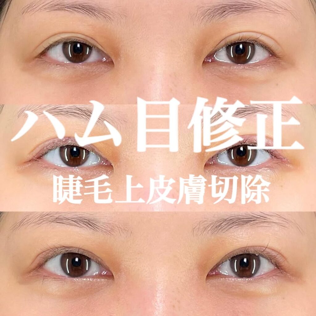 ハム目修正 睫毛上皮膚切除 症例