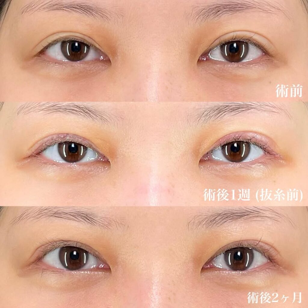 ハム目修正 睫毛上皮膚切除 症例