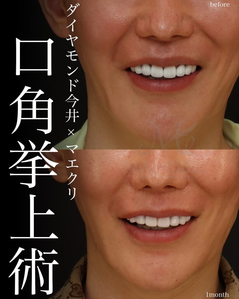 口角挙上症例