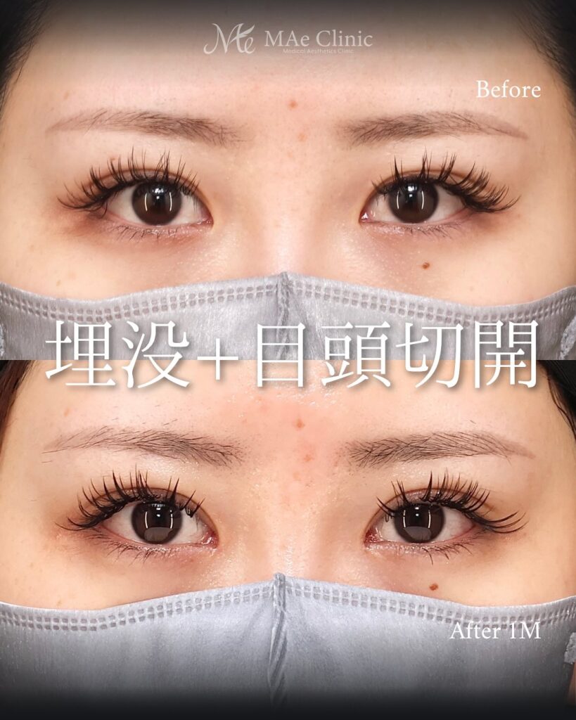 埋没　目頭切開　症例