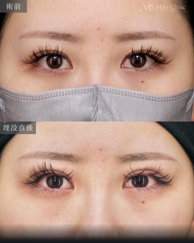 埋没　目頭切開　症例
