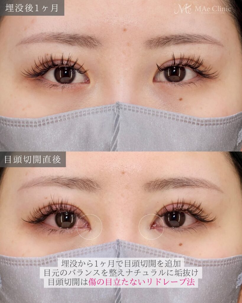 埋没　目頭切開　症例