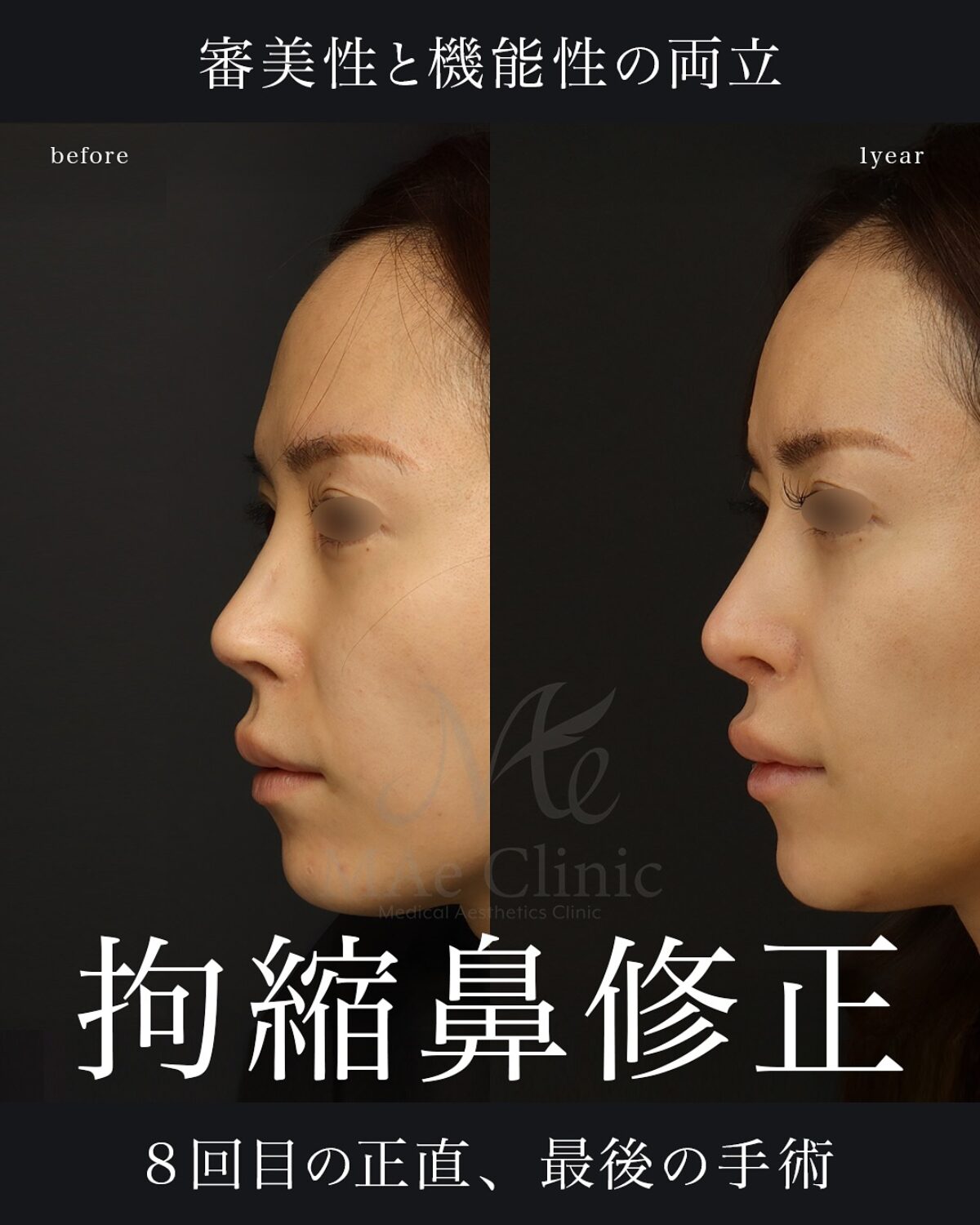 8回目の正直」──拘縮と鼻閉に悩んだ鼻を、再建で呼吸と自然な形に