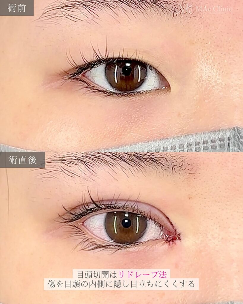 二重埋没 目頭切開 症例