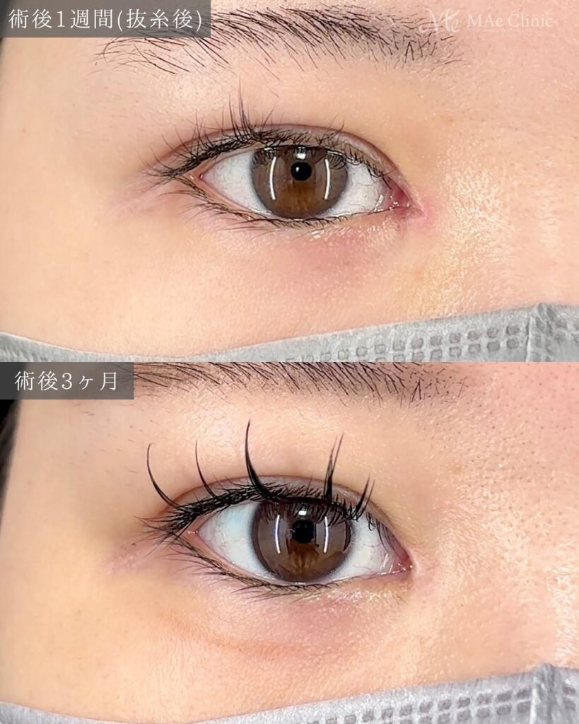 二重埋没 目頭切開 症例