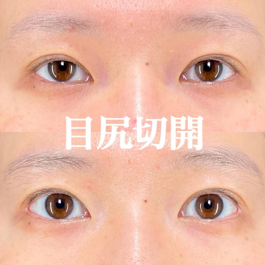 目尻切開 術後3ヵ月 症例