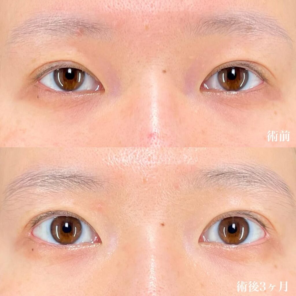 目尻切開 術後3ヵ月 症例