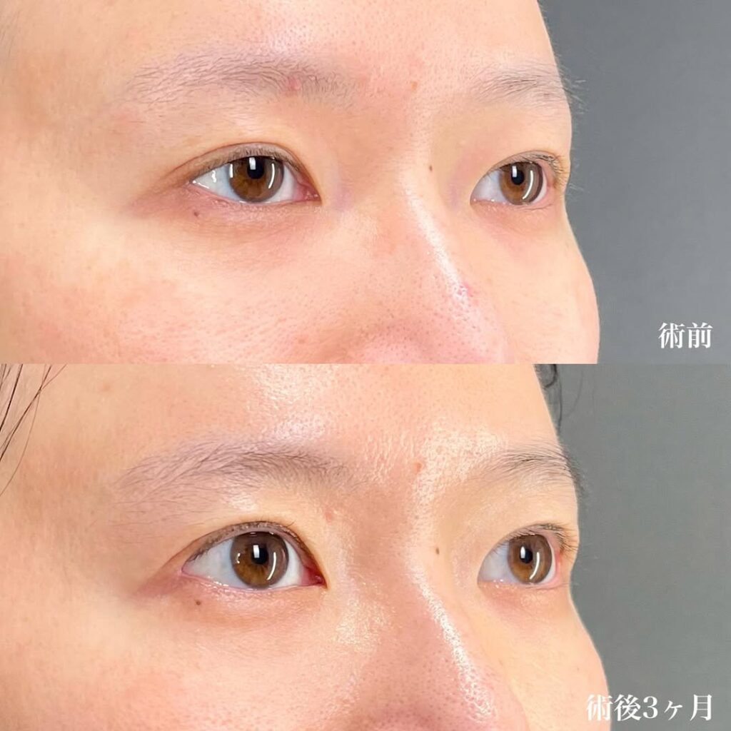 目尻切開 術後3ヵ月 症例