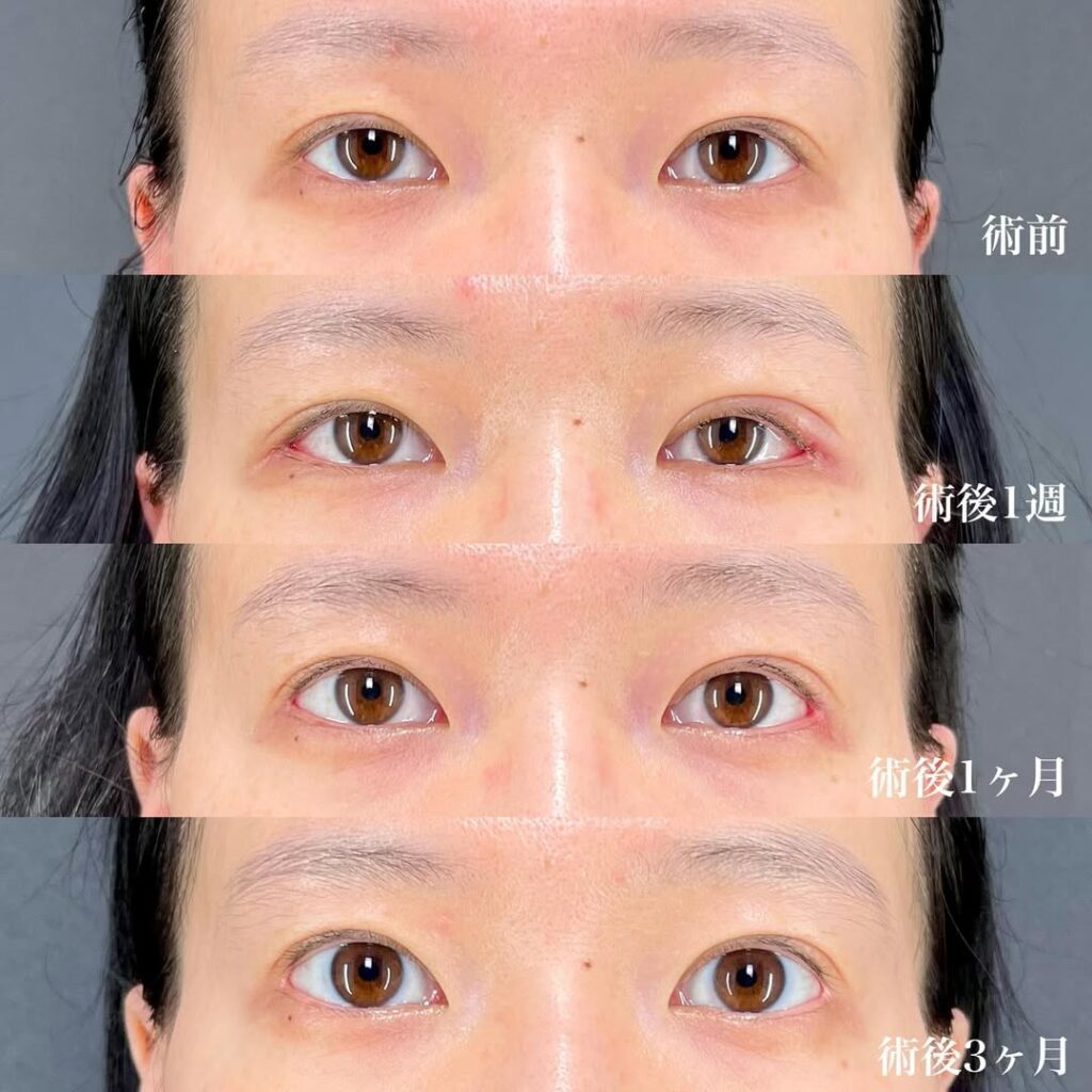 目尻切開 術後3ヵ月 症例