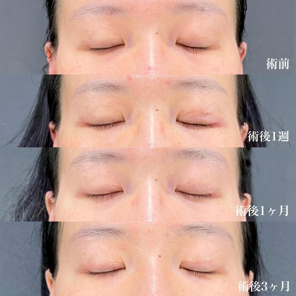目尻切開 術後3ヵ月 症例
