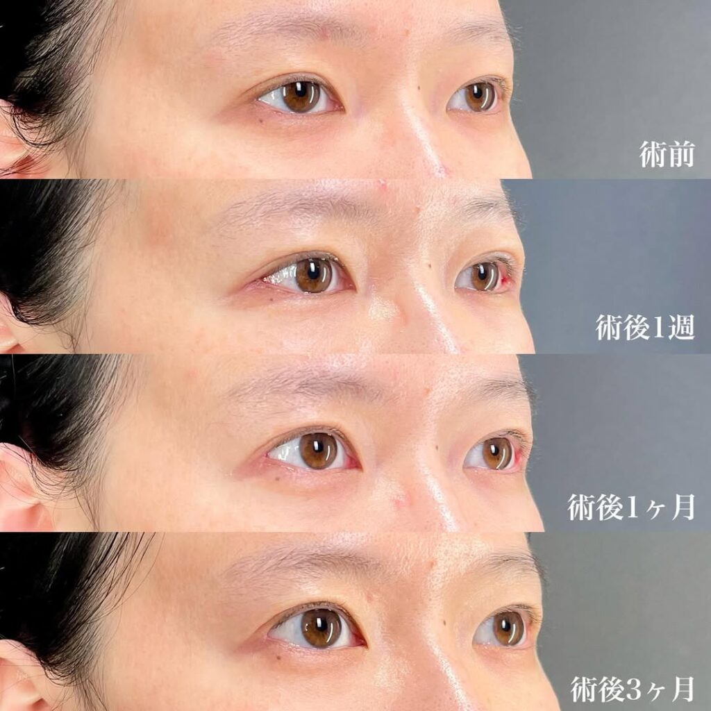 目尻切開 術後3ヵ月 症例