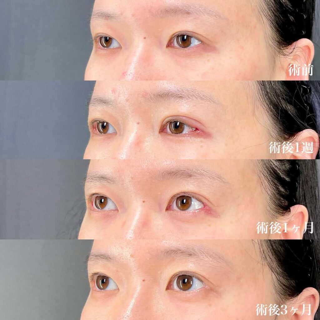 目尻切開 術後3ヵ月 症例