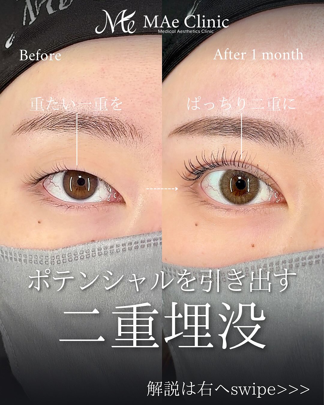 二重埋没　症例