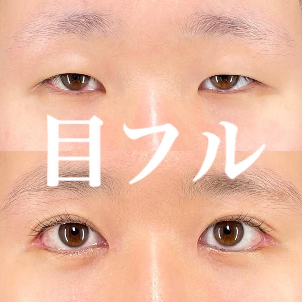 目フル症例