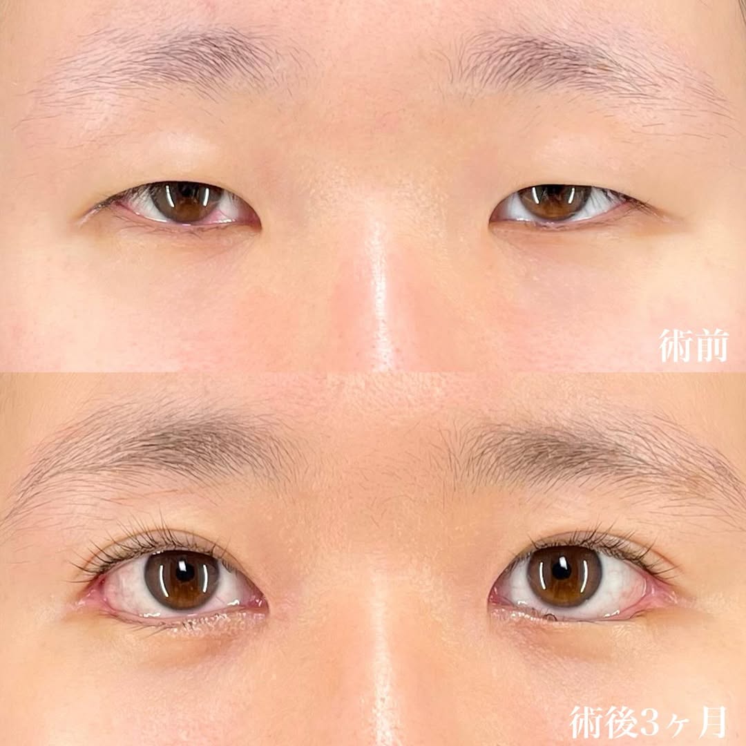目フル症例