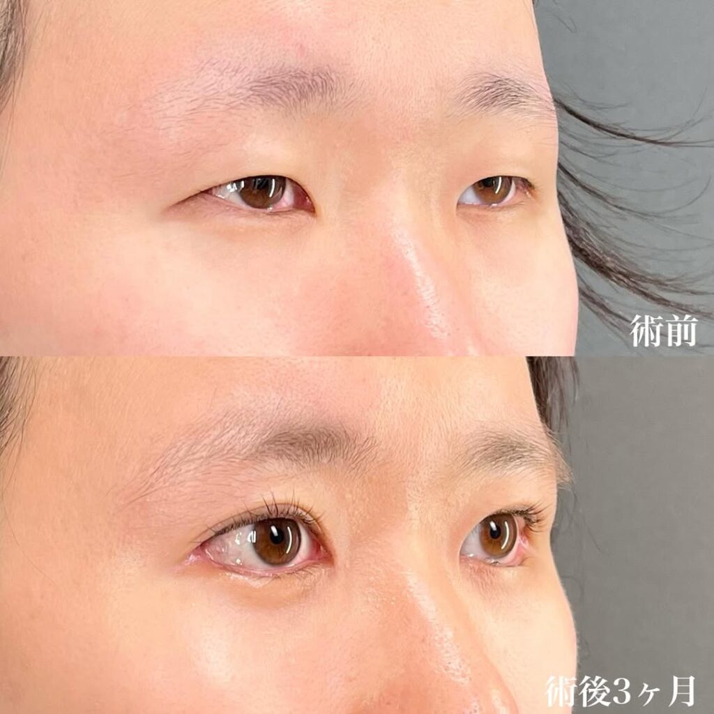 目フル症例