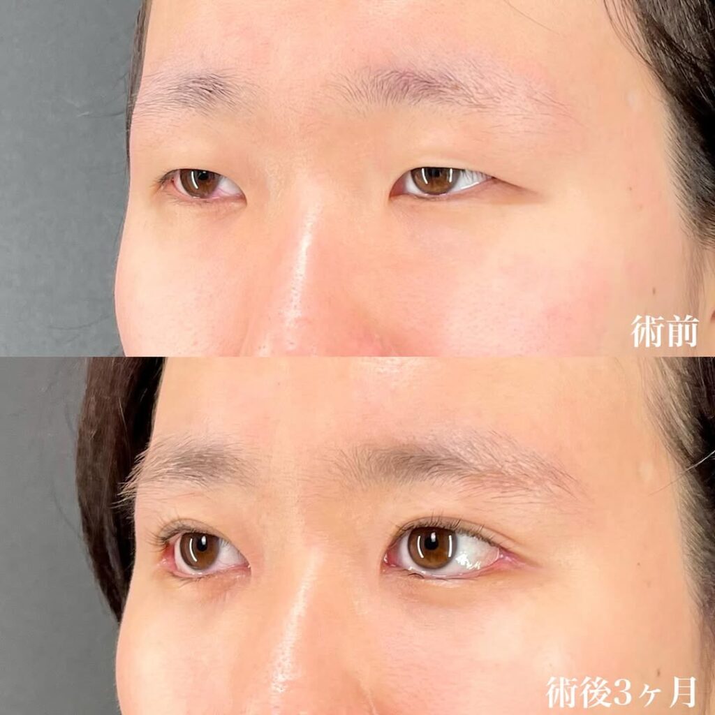 目フル症例