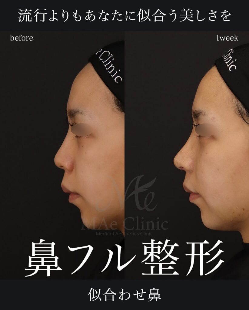 鼻中隔延長(肋軟骨)
鼻尖形成
鼻尖軟骨移植
猫手術(肋軟骨)