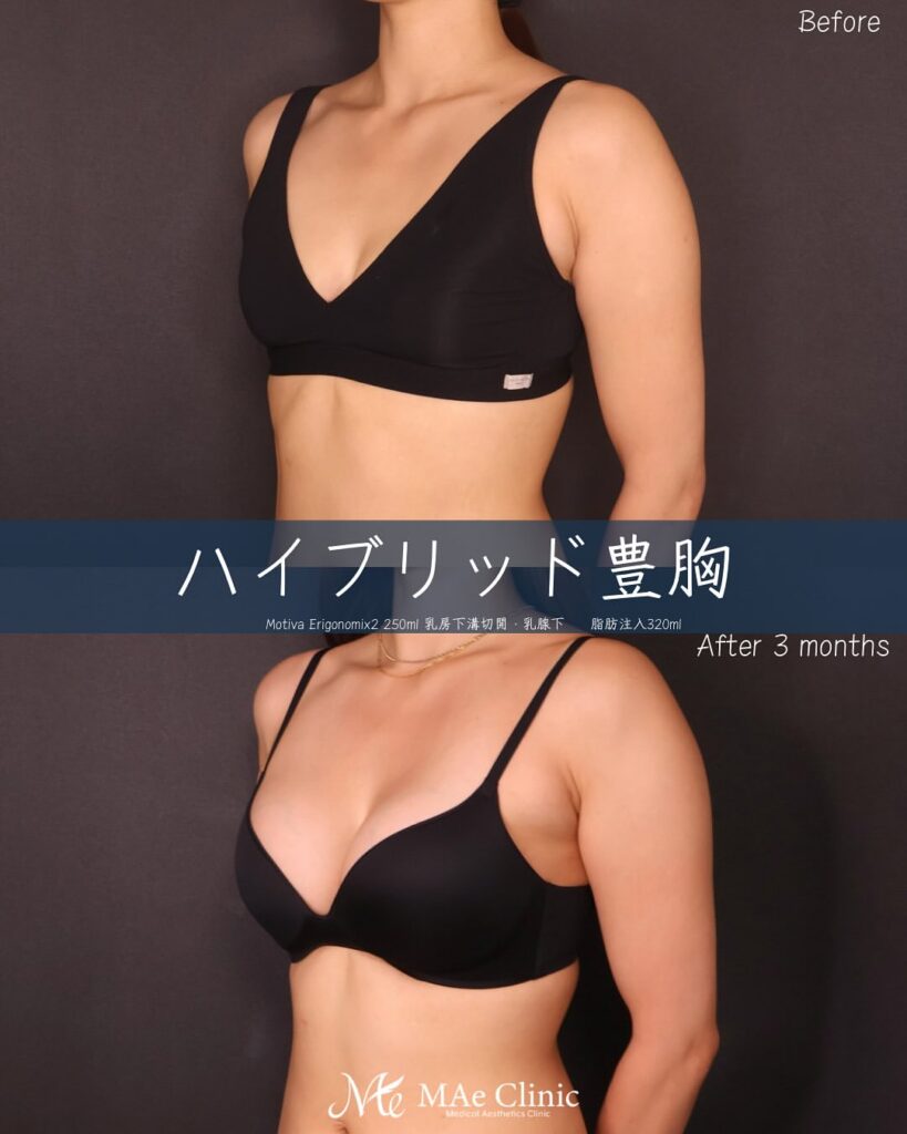 ハイブリッド豊胸　症例