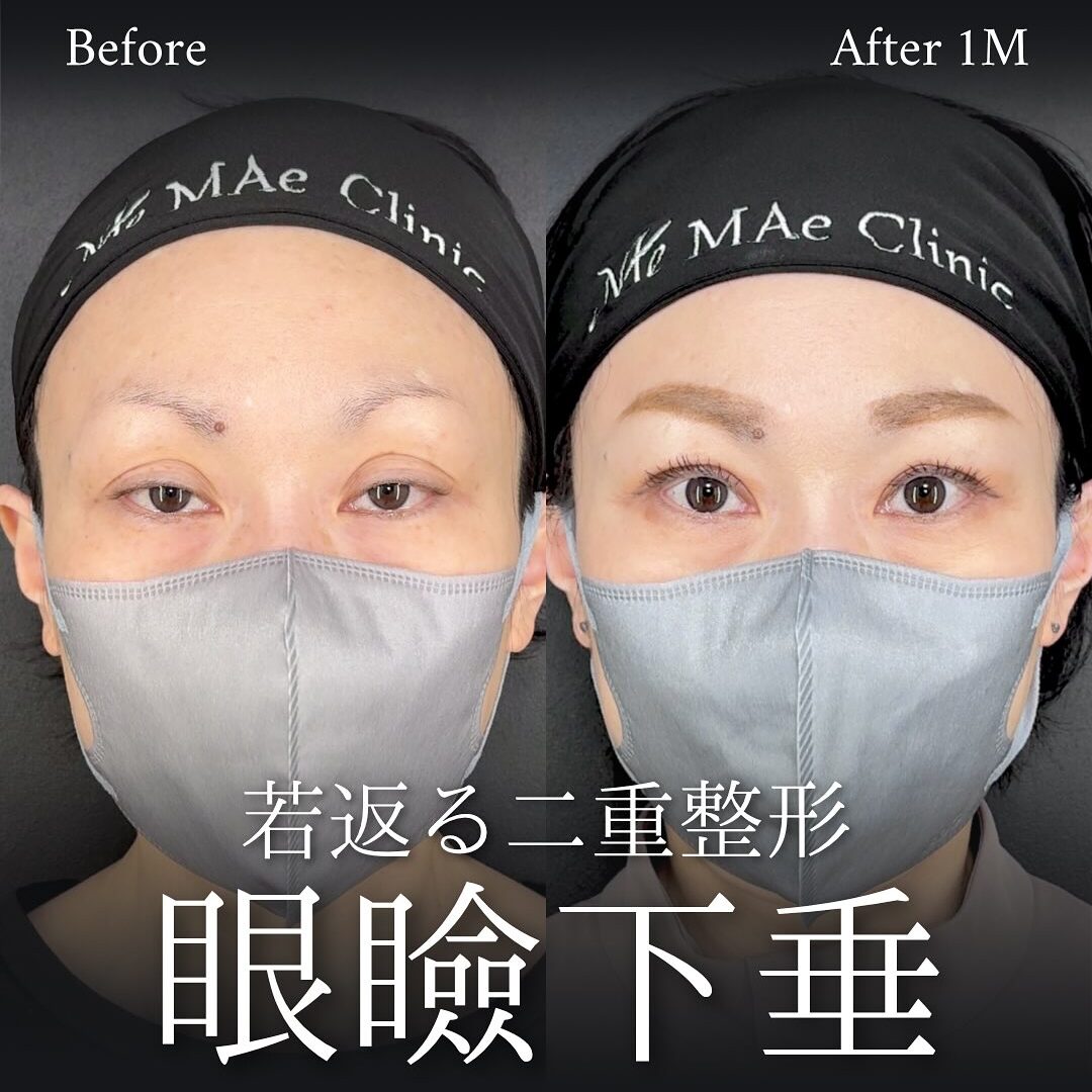 眠たそうな“窪み目”を若返らせた眼瞼下垂手術の症例 | MAe Clinic
