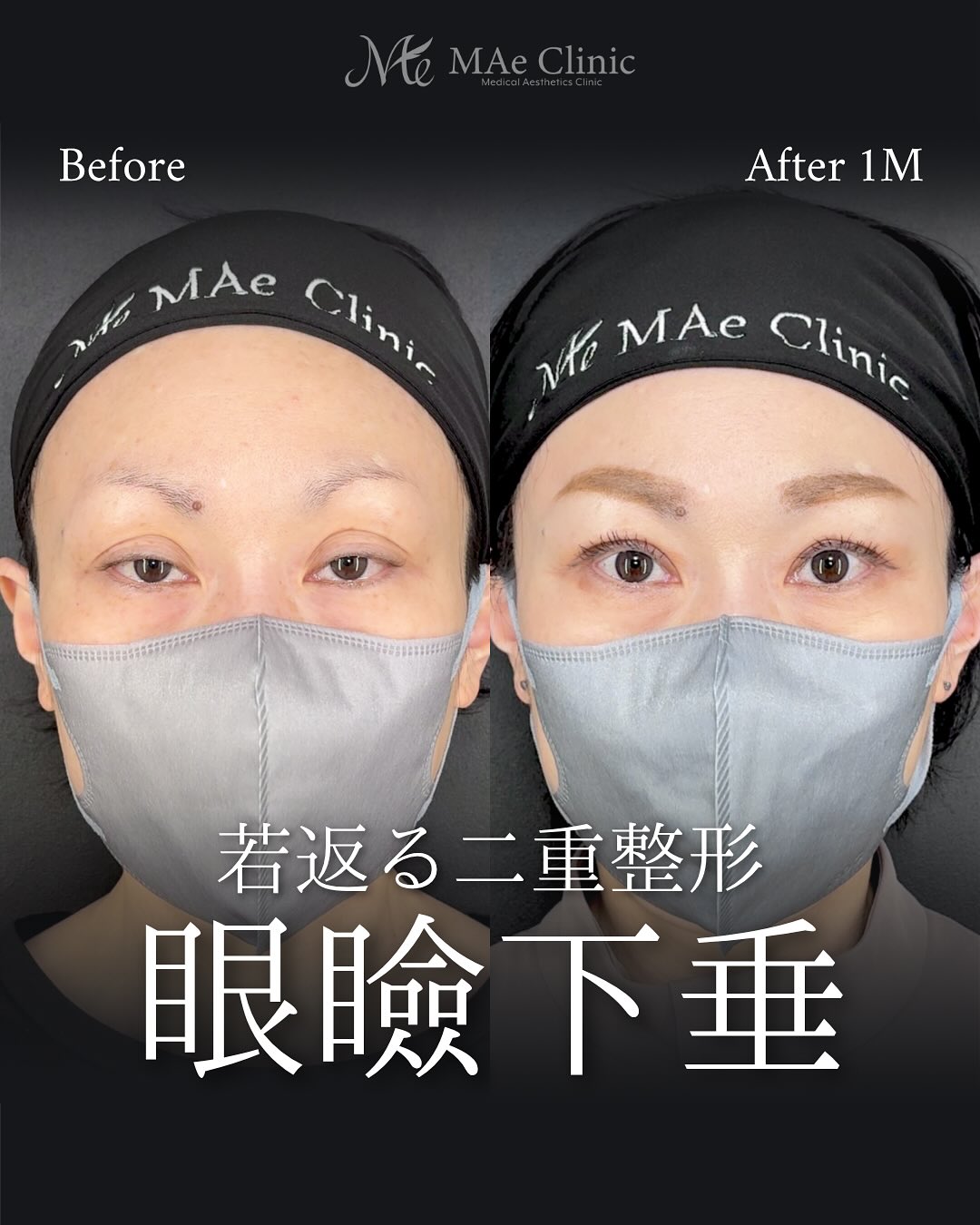 眠たそうな“窪み目”を若返らせた眼瞼下垂手術の症例 | MAe Clinic