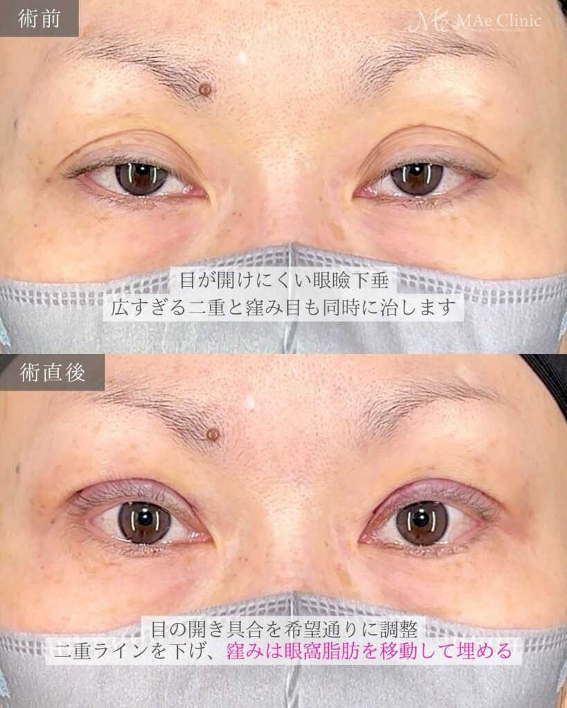 眼瞼下垂　症例