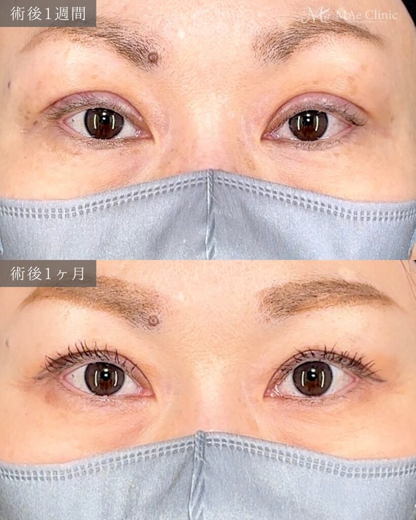 眼瞼下垂　症例