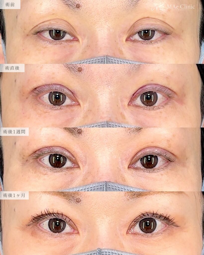 眼瞼下垂　症例