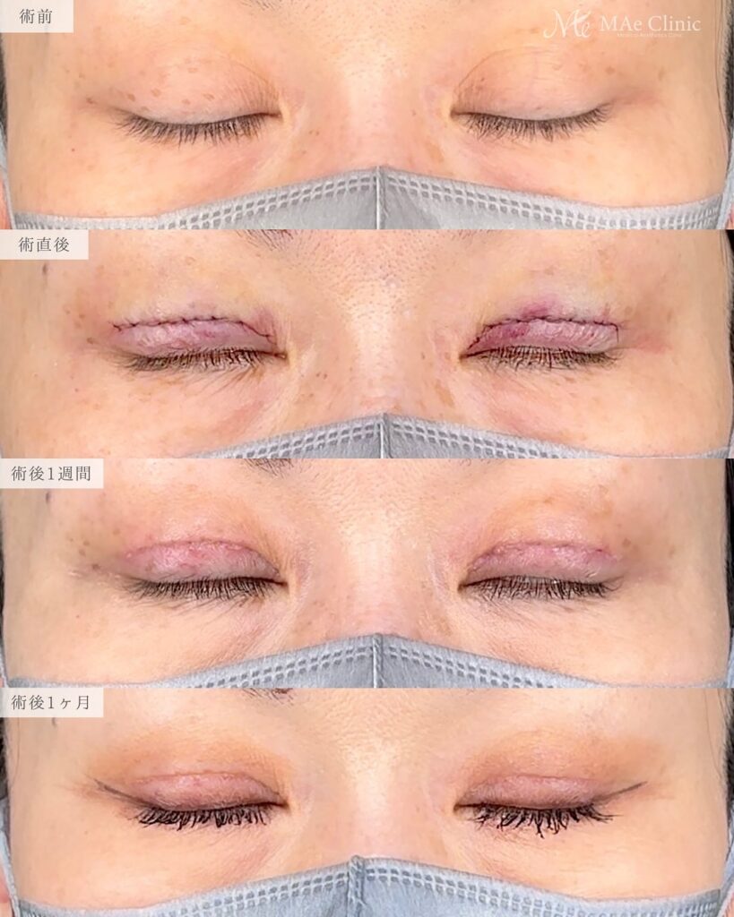 眼瞼下垂　症例