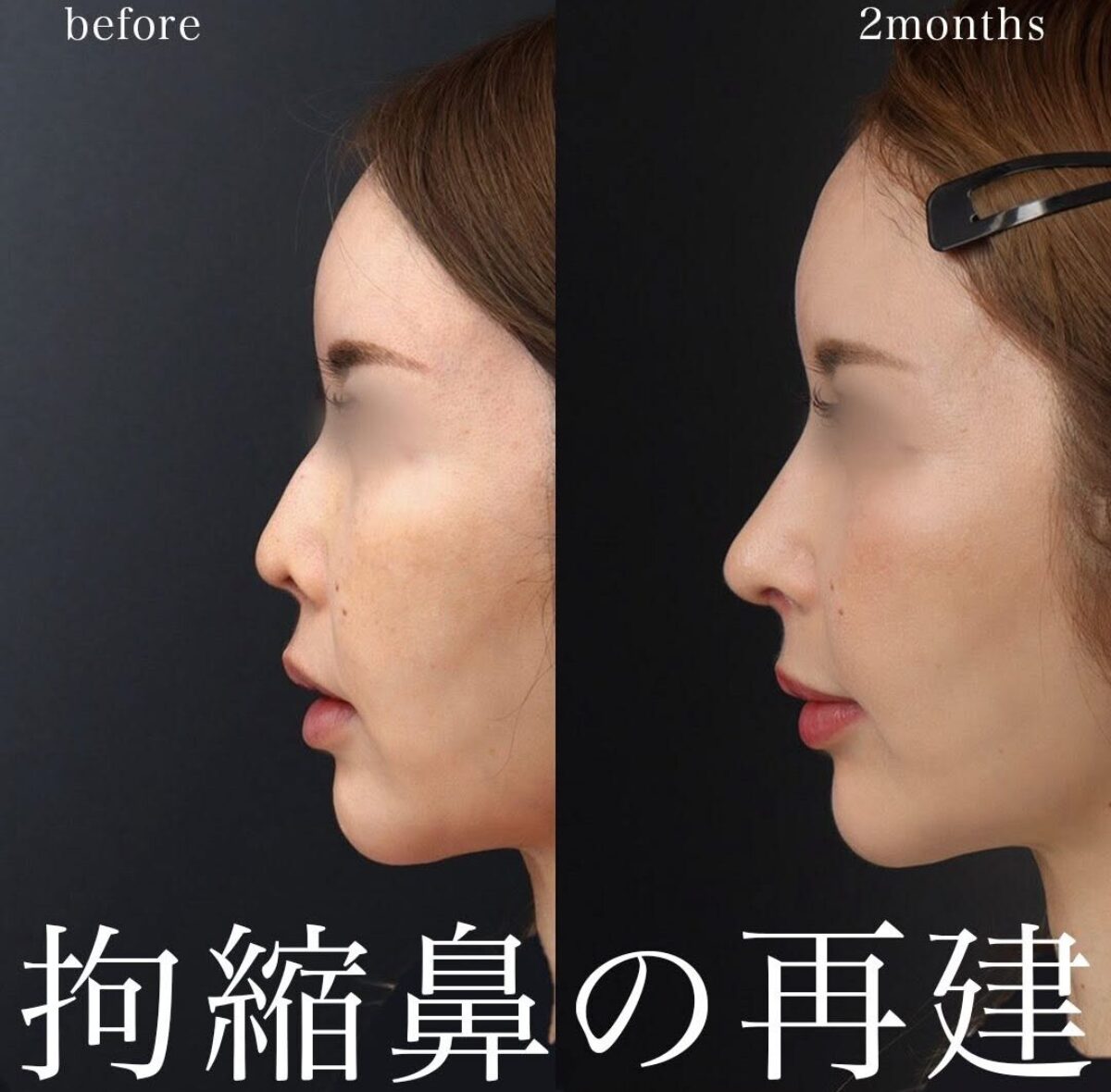 拘縮で短く上を向いた鼻を再建｜重度アップノーズを肋軟骨で整え